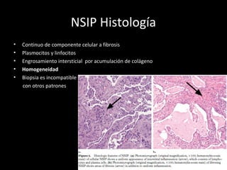 NSIP Histología
• Continuo de componente celular a fibrosis
• Plasmocitos y linfocitos
• Engrosamiento intersticial por acumulación de colágeno
• Homogeneidad
• Biopsia es incompatible
con otros patrones
 