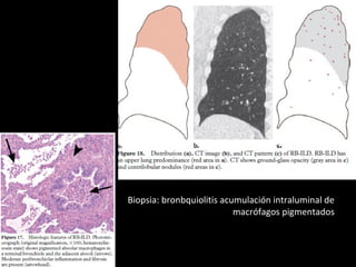 • Biopsia: bronbquiolitis acumulación intraluminal de
macrófagos pigmentados
 