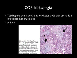 COP histología
• Tejido granulación dentro de los ductos alveolares asociado a
infiltrados mononucleares
• pólipos
 