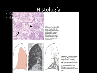 Histología• DAD fase aguda exudativa, proliferativa y fibrótica.
• Edema,, proliferación fb y neumocito2, deposición de colágeno
 