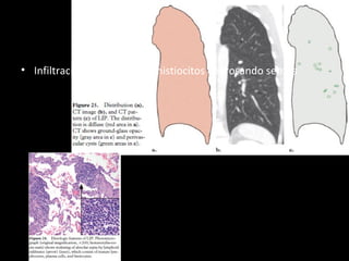 • Infiltración de linfocitos e histiocitos engrosando septos
 
