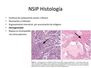 NSIP Histología
• Continuo de componente celular a fibrosis
• Plasmocitos y linfocitos
• Engrosamiento intersticial por acumulación de colágeno
• Homogeneidad
• Biopsia es incompatible
con otros patrones
 