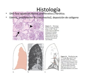 Histología• DAD fase aguda exudativa, proliferativa y fibrótica.
• Edema,, proliferación fb y neumocito2, deposición de colágeno
 