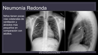 Neumonía Redonda
• http://westjem.com/images-in-emergency-medicine/evolution-
of-a-round-pneumonia.html
Niños tienen pocas
vías colaterales de
ventilación y
alveolos mas
pequeños en
comparación con
adultos.
 