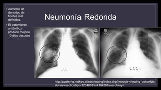 Neumonía Redonda
• Aumento de
densidad de
bordes mal
definidos.
• El tratamiento
antibiótico
produce mejoría
10 días después
http://posterng.netkey.at/esr/viewing/index.php?module=viewing_poster&ta
sk=viewsection&pi=123408&ti=410426&searchkey=
 