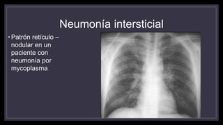 Neumonía intersticial
• Patrón retículo –
nodular en un
paciente con
neumonía por
mycoplasma
 
