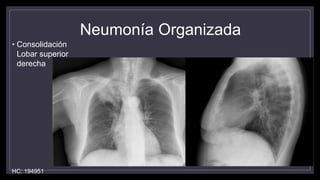 Neumonía Organizada
• Consolidación
Lobar superior
derecha
HC: 194951
 