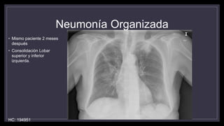 Neumonía Organizada
• Mismo paciente 2 meses
después
• Consolidación Lobar
superior y inferior
izquierda.
HC: 194951
 