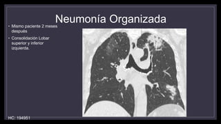 Neumonía Organizada• Mismo paciente 2 meses
después
• Consolidación Lobar
superior y inferior
izquierda.
HC: 194951
 