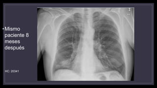 •Mismo
paciente 8
meses
después
HC: 20341
 