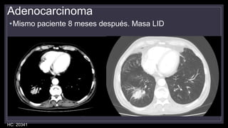 Adenocarcinoma
•Mismo paciente 8 meses después. Masa LID
HC: 20341
 