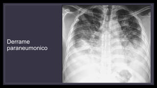 Derrame
paraneumonico
 