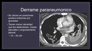 Derrame paraneumonico
• Se ubican en posiciones
postero-inferiores por
gravedad
• Tienen menor densidad
que las atelectasias, masas
pleurales o engrosamiento
pleural.
• 10 – 20 UH
 