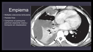 Empiema
• Múltiples colecciones lenticulares
• Paredes finas
• Comprimen el parénquima
pulmonar adyacente (vasos y
bronquios son desplazados)
 