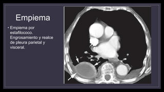 Empiema
• Empiema por
estafilococo.
Engrosamiento y realce
de pleura parietal y
visceral.
 