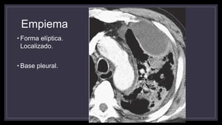 Empiema
• Forma elíptica.
Localizado.
• Base pleural.
 