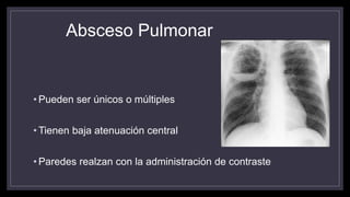 Absceso Pulmonar
• Pueden ser únicos o múltiples
• Tienen baja atenuación central
• Paredes realzan con la administración de contraste
 