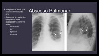Absceso Pulmonar• Imagen focal en LII que
contiene nivel liquido
aire.
• Sospechar en pacientes
que puedan tener
aspiración hacia la vía
aérea.
• Alcoholismo
• ECV
• Epilepsia
• Ancianos
 