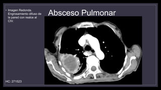 Absceso Pulmonar
• Imagen Redonda.
Engrosamiento difuso de
la pared con realce al
CIV.
HC: 271523
 