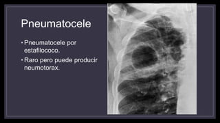 Pneumatocele
• Pneumatocele por
estafilococo.
• Raro pero puede producir
neumotorax.
 