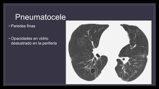 Pneumatocele
• Paredes finas
• Opacidades en vidrio
deslustrado en la periferia
 