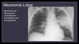 Neumonía Lobar
• Neumonía por
Neumococo,
consolidación
homogénea con
broncograma.
 