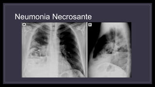 Neumonia Necrosante
 