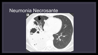 Neumonia Necrosante
 