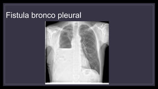 Fistula bronco pleural
 