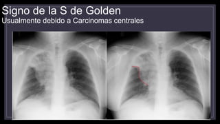 Signo de la S de Golden
Usualmente debido a Carcinomas centrales
 