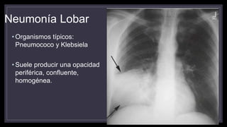 Neumonía Lobar
• Organismos típicos:
Pneumococo y Klebsiela
• Suele producir una opacidad
periférica, confluente,
homogénea.
 