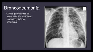Bronconeumonía
• Áreas parcheadas de
consolidación en lóbulo
superior y inferior
izquierdo
 