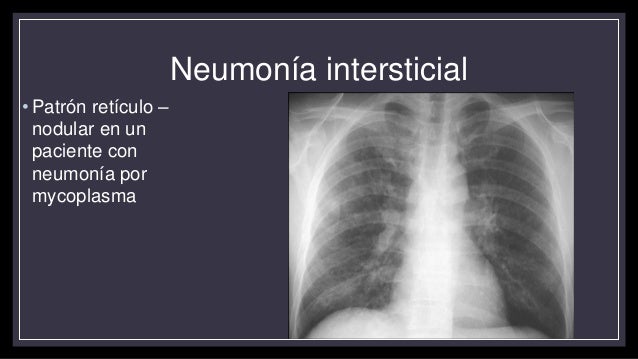 Neumonías y complicaciones