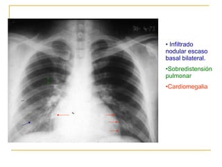 Infiltrado nodular escaso basal bilateral. Sobredistensión pulmonar Cardiomegalia 