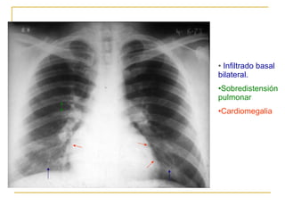 Infiltrado basal bilateral. Sobredistensión pulmonar Cardiomegalia 