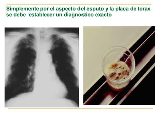 Simplemente por el aspecto del esputo y la placa de torax se debe  establecer un diagnostico exacto 