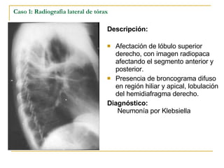 Caso 1: Radiografía lateral de tórax Descripción: Afectación de lóbulo superior derecho, con imagen radiopaca afectando el segmento anterior y posterior.  Presencia de broncograma difuso en región hiliar y apical, lobulación del hemidiafragma derecho. Diagnóstico:  Neumonía por Klebsiella 
