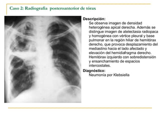 Caso 2: Radiografía  posteroanterior de tórax Descripción: Se observa imagen de densidad heterogénea apical derecha. Además se distingue imagen de atelectasia radiopaca y homogénea con vértice pleural y base pulmonar en la región hiliar de hemitórax derecho, que provoca desplazamiento del mediastino hacia el lado afectado y elevación del hemidiafragma derecho. Hemitórax izquierdo con sobredistensión y ensanchamiento de espacios intercostales. Diagnóstico:   Neumonía por Klebsiella 