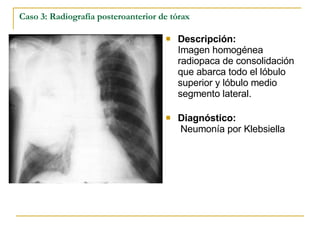 Caso 3: Radiografía posteroanterior de tórax Descripción: Imagen homogénea  radiopaca de consolidación que abarca todo el lóbulo superior y lóbulo medio segmento lateral. Diagnóstico:  Neumonía por Klebsiella 