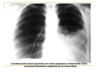 Condensación basal izquierda con mala respuesta a tratamiento como neumonía bacteriana adquirida en la comunidad.   