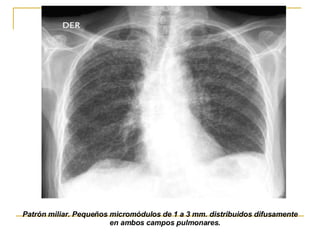 Patrón miliar. Pequeños micromódulos de 1 a 3 mm. distribuidos difusamente en ambos campos pulmonares.   