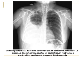 Derrame pleural basal. El estudio del líquido pleural demostró tuberculosis. La presencia de un derrame pleural en un paciente joven relativamente asintomático es altamente sugerente de tuberculosis.   