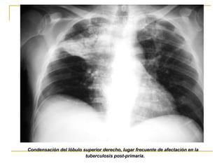 Condensación del lóbulo superior derecho, lugar frecuente de afectación en la tuberculosis post-primaria .   