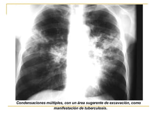 Condensaciones múltiples, con un área sugerente de excavación, como manifestación de tuberculosis .   