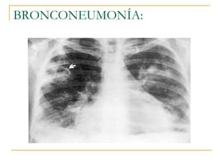 BRONCONEUMONÍA: 