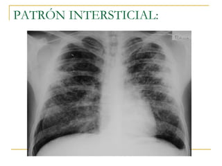 PATRÓN INTERSTICIAL: 