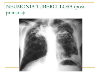 NEUMONÍA TUBERCULOSA (post-primaria): 