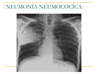 NEUMONÍA NEUMOCOCÍCA: 