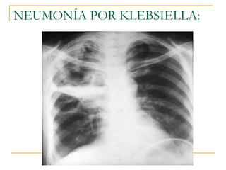 NEUMONÍA POR KLEBSIELLA: 