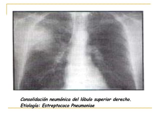 Consolidación neumónica del lóbulo superior derecho.  Etiología: Estreptococo Pneumoniae 